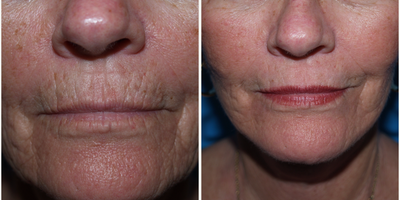 Dermabrasion before and after photo