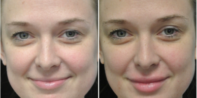 Lip Fillers before and after photo