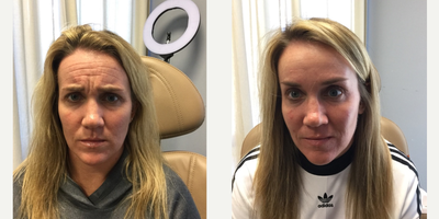 Botox before and after photo