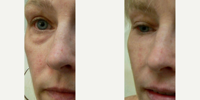 Dermal Fillers before and after photo