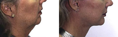 Facelift before and after photo