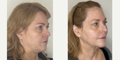 before and after image
