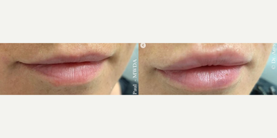 Dermal Fillers before and after photo