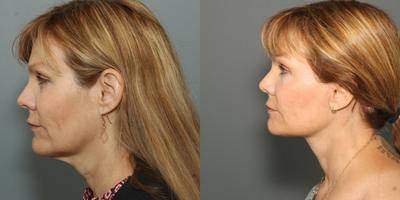Facelift before and after photo