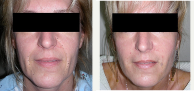 Juvederm before and after photo