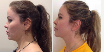 Kybella before and after photo