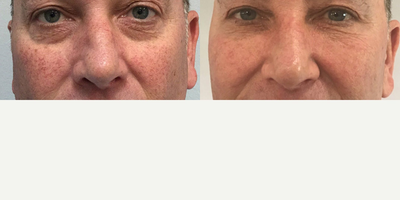 Microneedling before and after photo