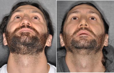 Revision Rhinoplasty before and after photo