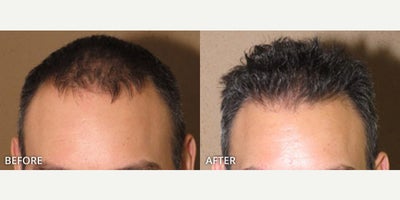 Hair Transplant before and after photo