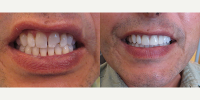 Porcelain Veneers before and after photo
