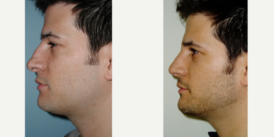 Rhinoplasty before and after photo