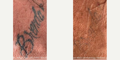 Tattoo Removal before and after photo