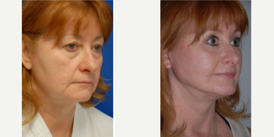 Brow Lift before and after photo