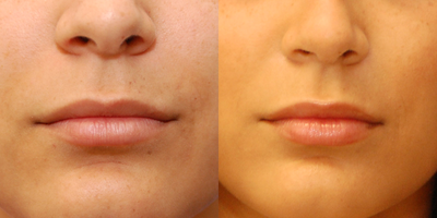 Lip Fillers before and after photo