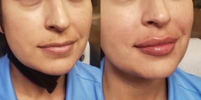 Lip Fillers before and after photo