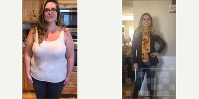 Orbera Gastric Balloon before and after photo