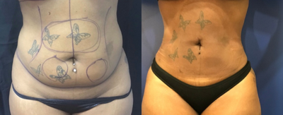 Smart Lipo before and after photo