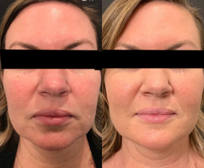 Botox before and after photo