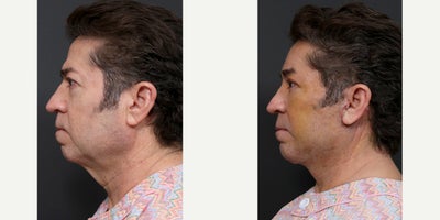 Brow Lift before and after photo