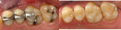 Dental Crown before and after photo
