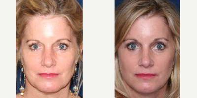 Facelift before and after photo