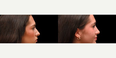 Rhinoplasty before and after photo