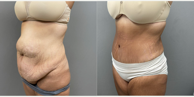 Tummy Tuck before and after photo