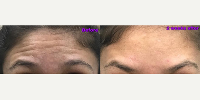 Botox before and after photo