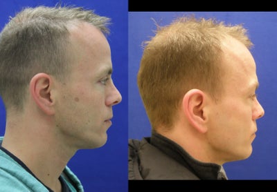Fractional Laser before and after photo