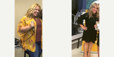 Gastric Sleeve Surgery before and after photo