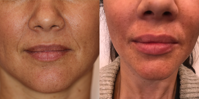 Juvederm before and after photo