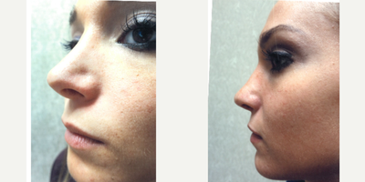 Revision Rhinoplasty before and after photo