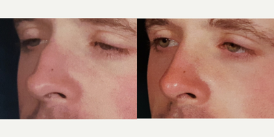 Rhinoplasty before and after photo