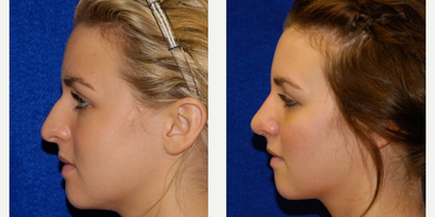 Rhinoplasty before and after photo