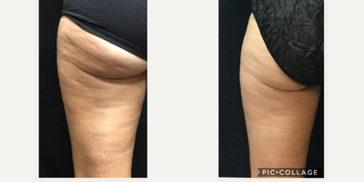 Skin Tightening before and after photo