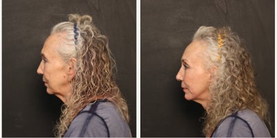 Laser Resurfacing before and after photo