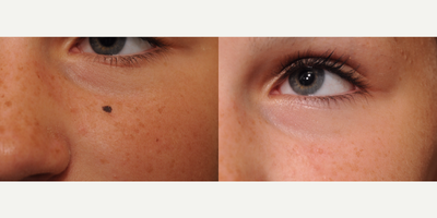 Mole Removal before and after photo