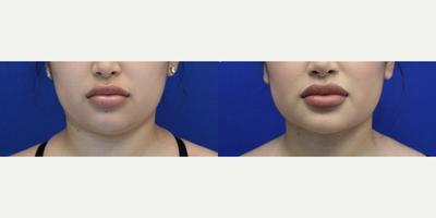 Neck Lift before and after photo