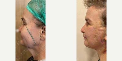 Neck Lift before and after photo