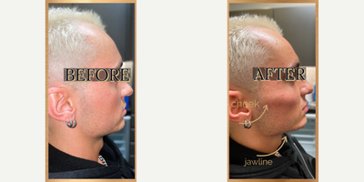 Nonsurgical Facelift before and after photo