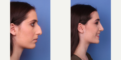 Rhinoplasty before and after photo