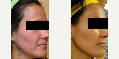IPL before and after photo