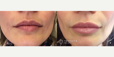Juvederm before and after photo