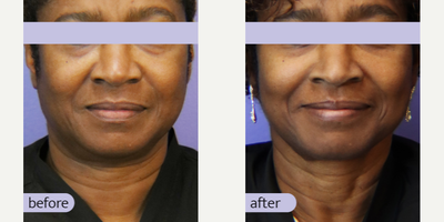 Eyelid Surgery before and after photo
