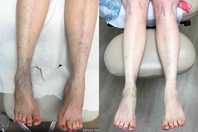 Sclerotherapy before and after photo