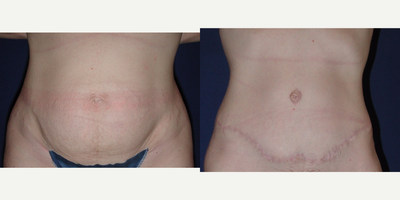 Tummy Tuck before and after photo