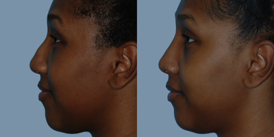 African American Rhinoplasty before and after photo