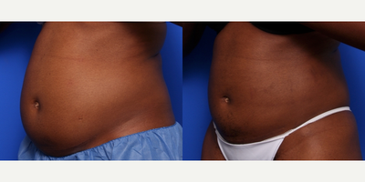 CoolSculpting before and after photo
