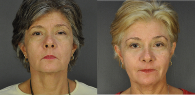 Eyelid Surgery before and after photo