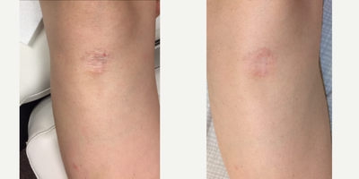 Fractional Laser before and after photo